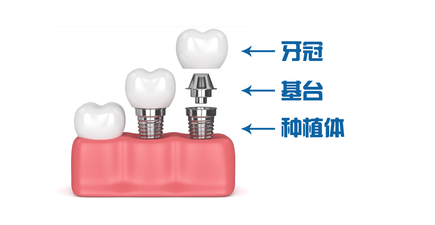即刻种植牙和常规传统种植牙区别是啥？