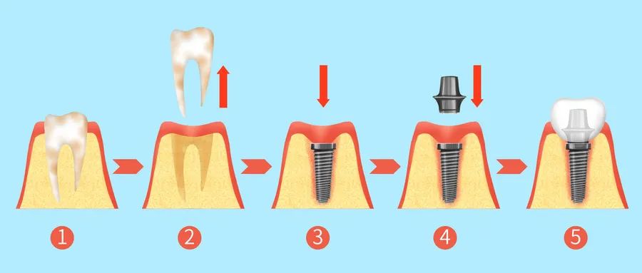 种植牙全过程——只需三步，堪比真牙！